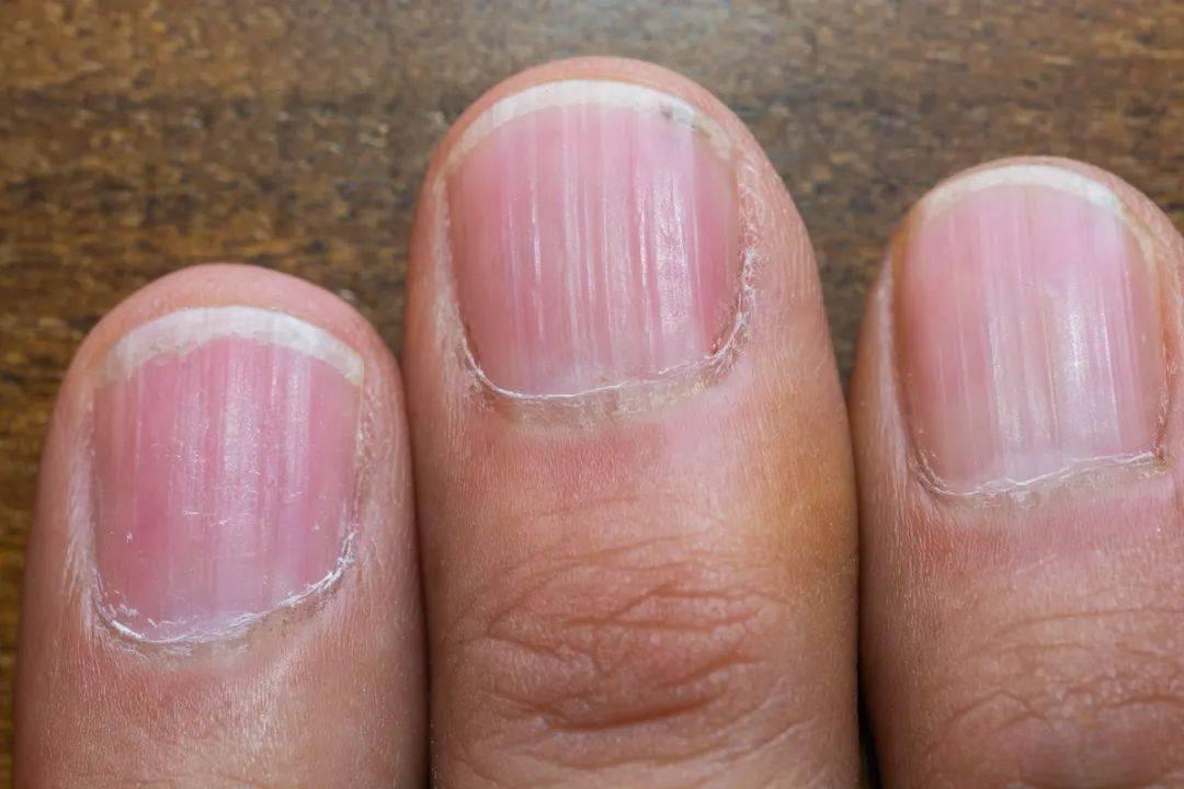 指甲上的小秘密:小竖纹竟是肝血不足的警报,这个中成药帮你轻松补回来!